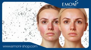 Beta Hydroxy Acids